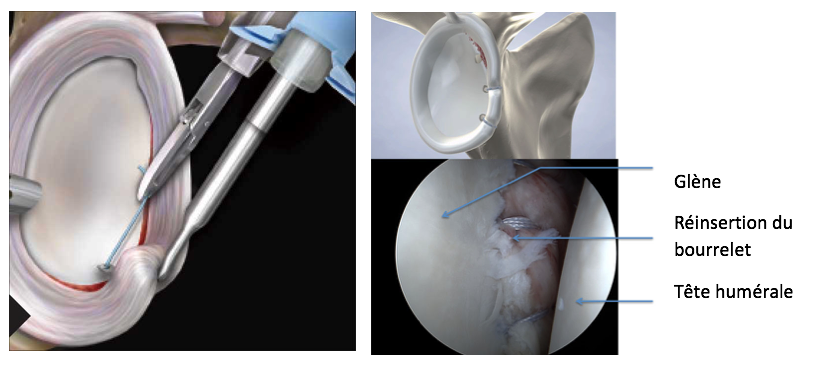 Bankart arthroscopique