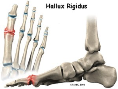 Hallux rigidus CHA