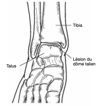 Lésions ostéochondrales de la cheville CHA