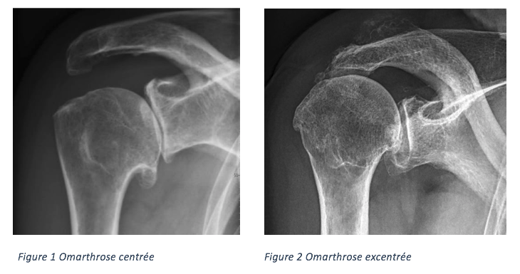 omarthrose centrée excentrée