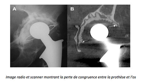 perte de congruence CHA