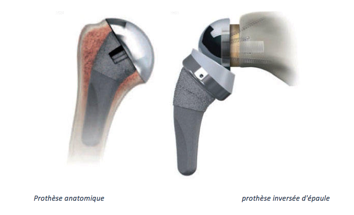 prothèse anatomique et inversée d'épaule