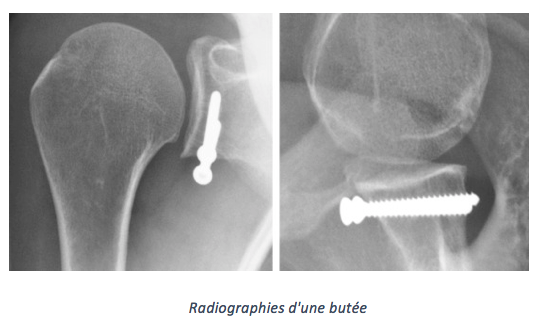 radiographie butées