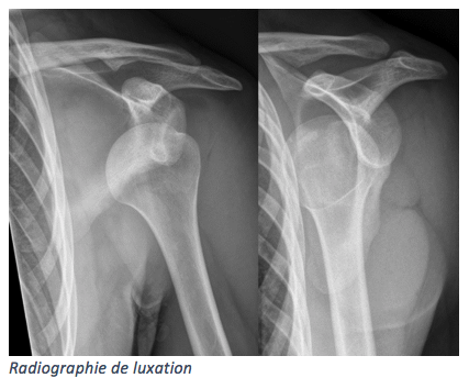 radiographie de luxation CHA