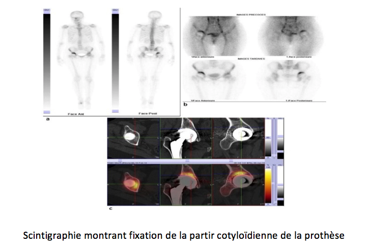  Scintigraphie  CHA