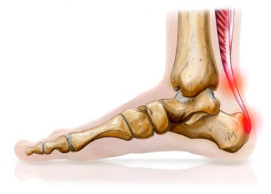 Tendinopathie achilléenne CHA