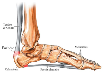 Tendinopathie d'insertion calcanéenne	CHA