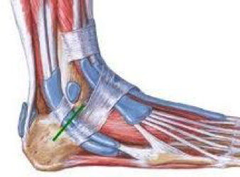 tendinopathie Fibulaire CHA