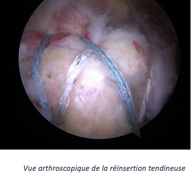  Vue arthroscopique de la réinsertion tendineuse CHA